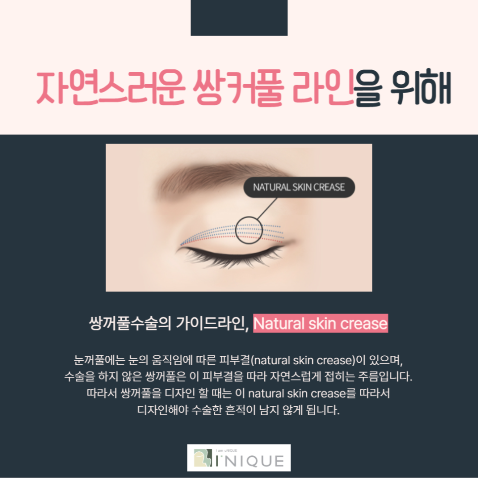 첫눈수술, 내 눈은 소중하니까! 관련 이미지 5