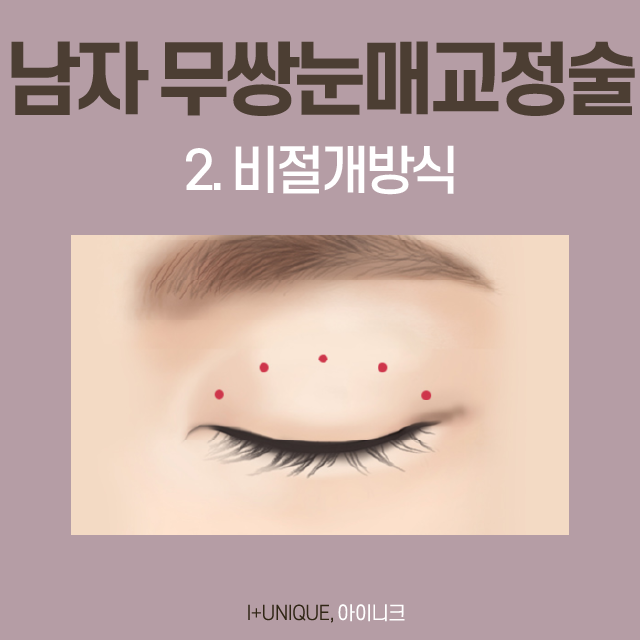 쌍꺼풀 없이도 또렷한 눈매를 원한다면 무쌍눈매교정술! 관련 이미지 6