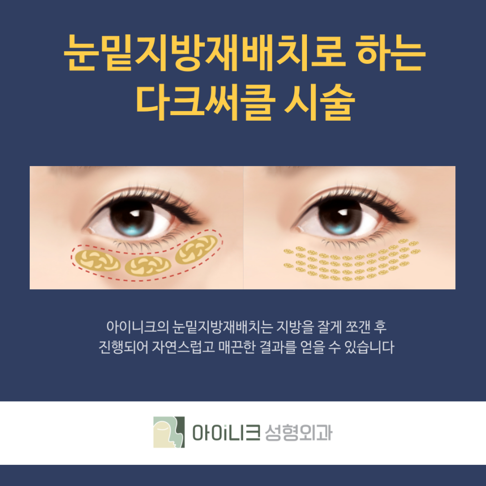 압구정다크서클 확실하게 개선하기 관련 이미지 5
