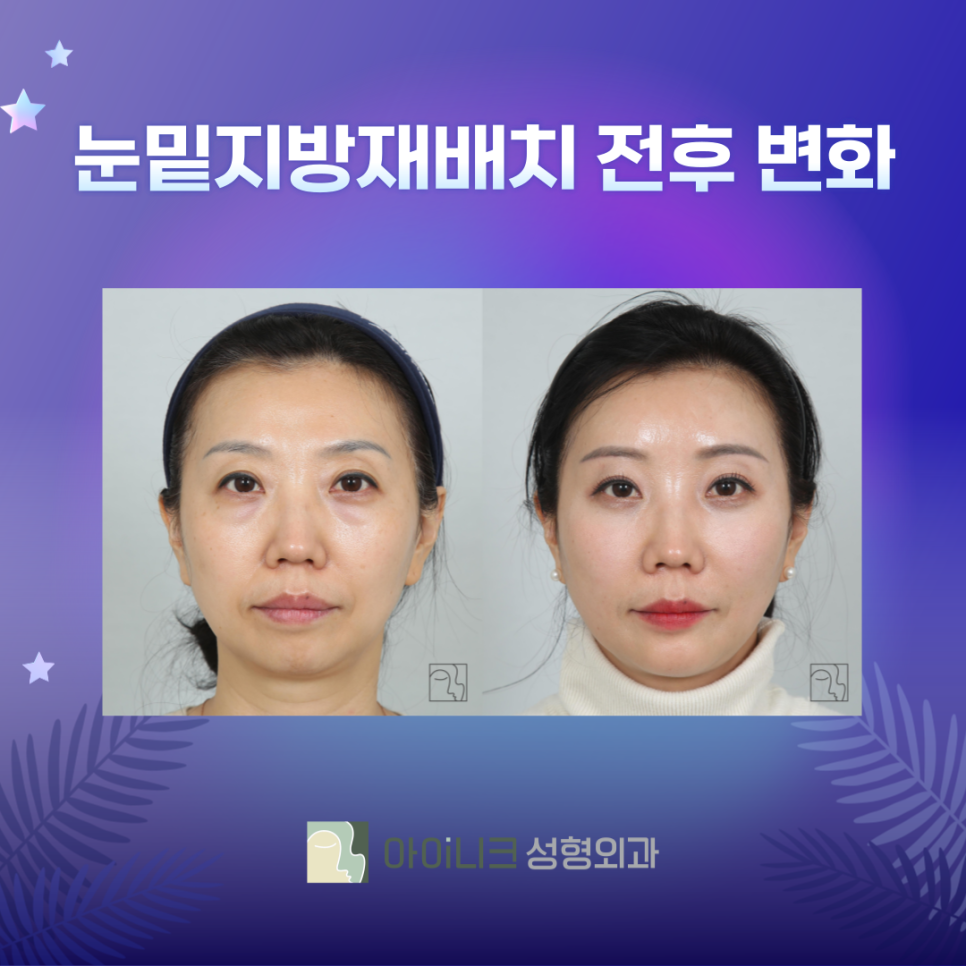 눈밑지방재배치추천병원 제대로 선택하려면? 관련 이미지 7