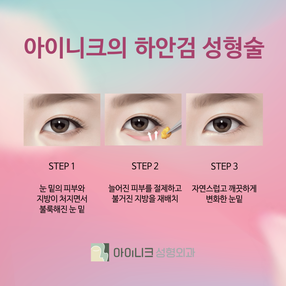 Apgujeong Lower Blepharoplasty for Brighter, Cleaner Under-Eyes image 5