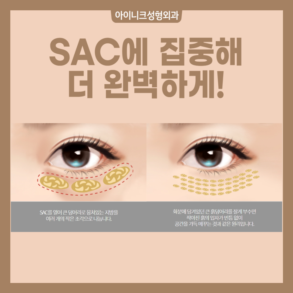 If Aging Can No Longer Be Delayed, Let’s Rejuvenate with Eye Rejuvenation Surgery! image 3