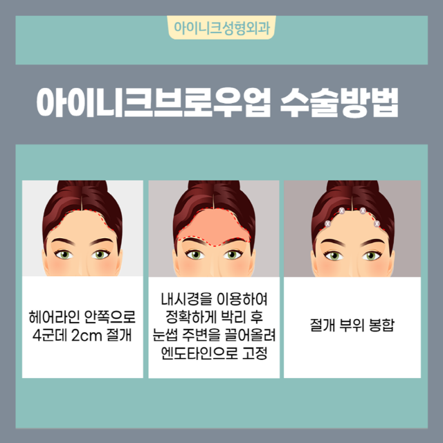 눈썹올림술 (브로우업) 아이니크와 제대로 알고 하자! 관련 이미지 3