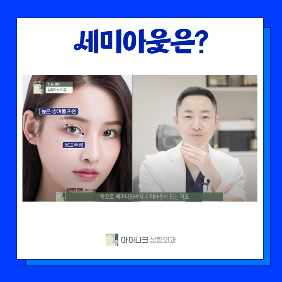 서울쌍꺼풀수술 잘하는 곳 알려드려요! 관련 이미지 4