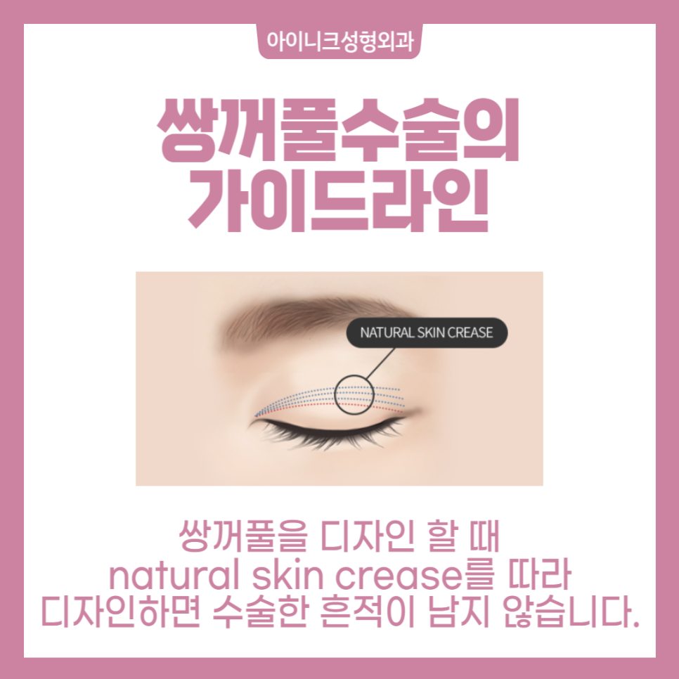 작은눈수술, 자연스러운 쌍꺼풀라인으로 관련 이미지 5