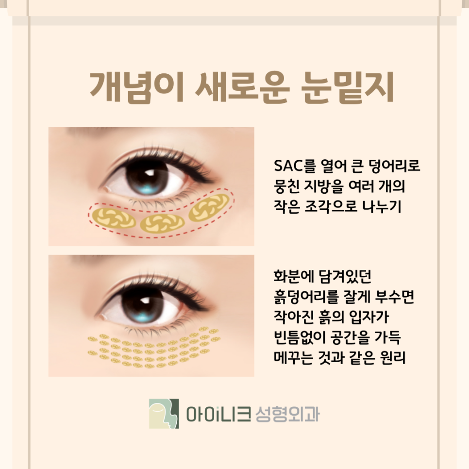 Improving a Tired-Looking Impression with Under-Eye Surgery in Apgujeong image 5