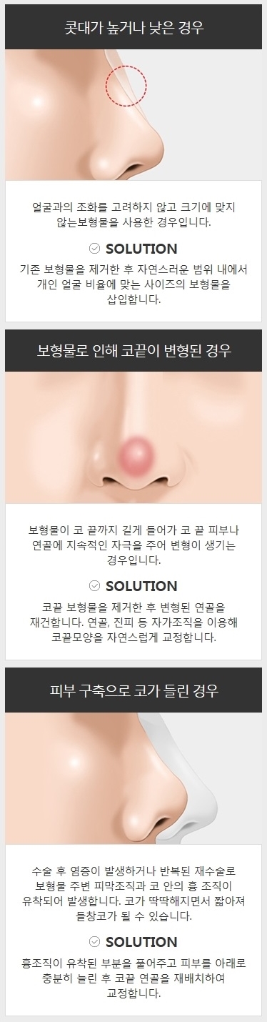 늑연골코성형 코재수술 잘하는 곳 관련 이미지 5