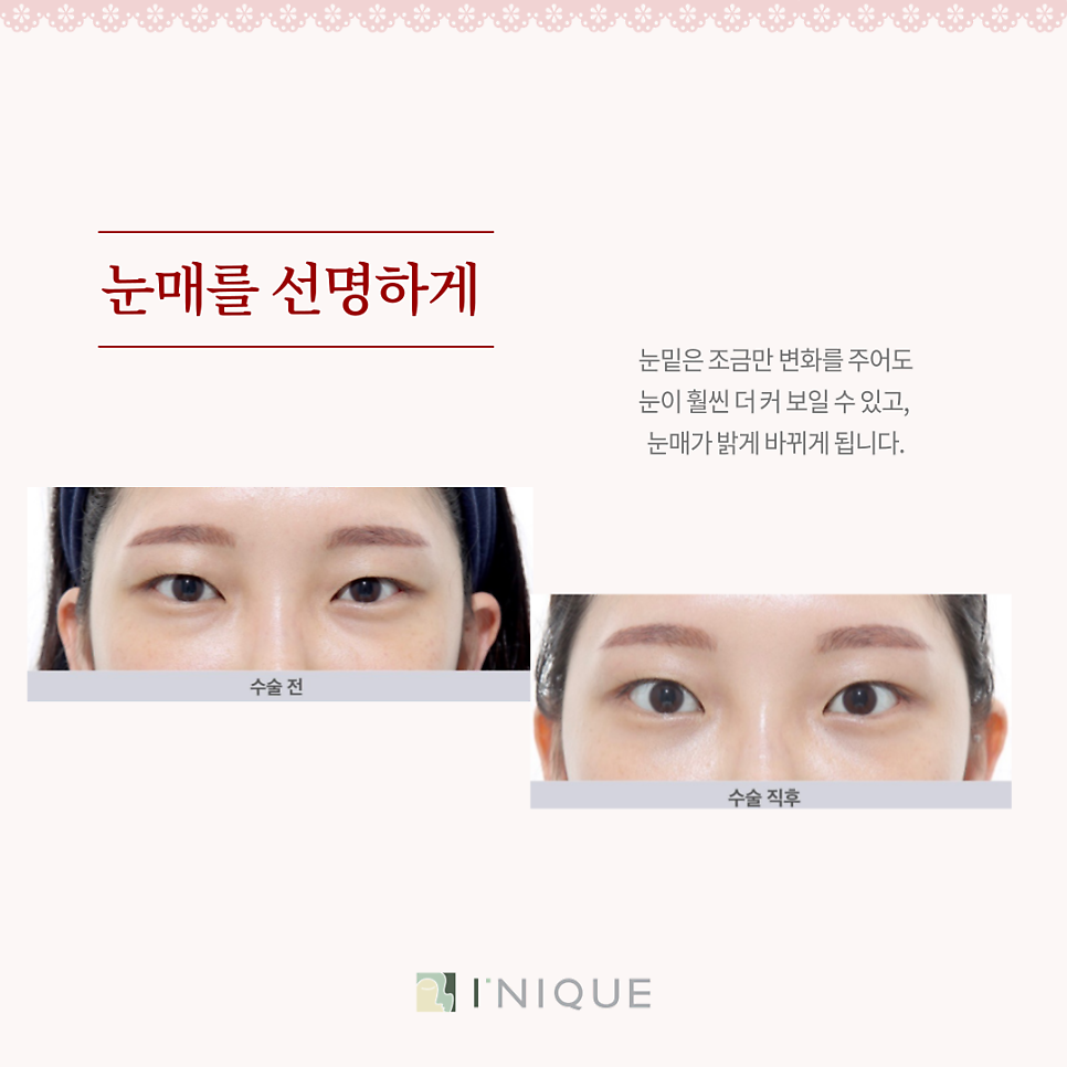 눈밑트임잘하는곳, 어떻게 선택할까요? 관련 이미지 5