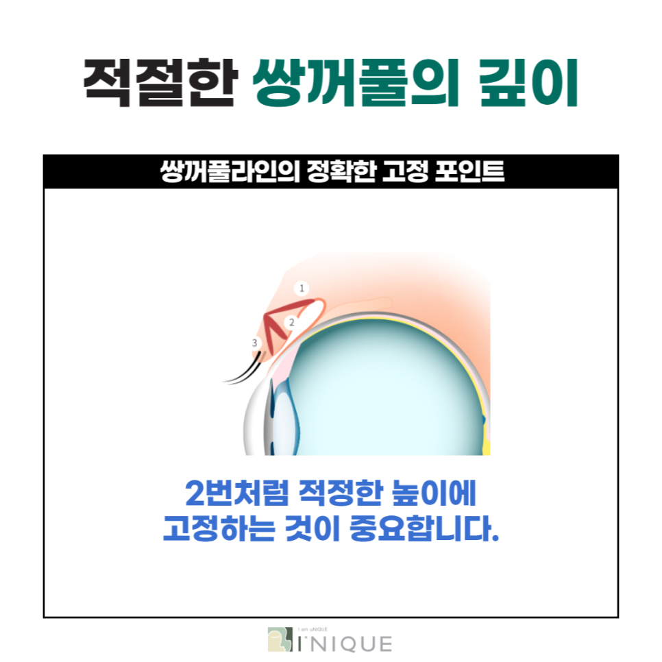 If You Want a Clear Change Before and After Double Eyelid Surgery image 3