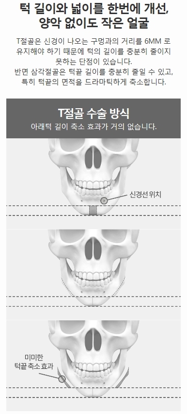 턱끝축소술비용 세련된 내 모습 관련 이미지 3