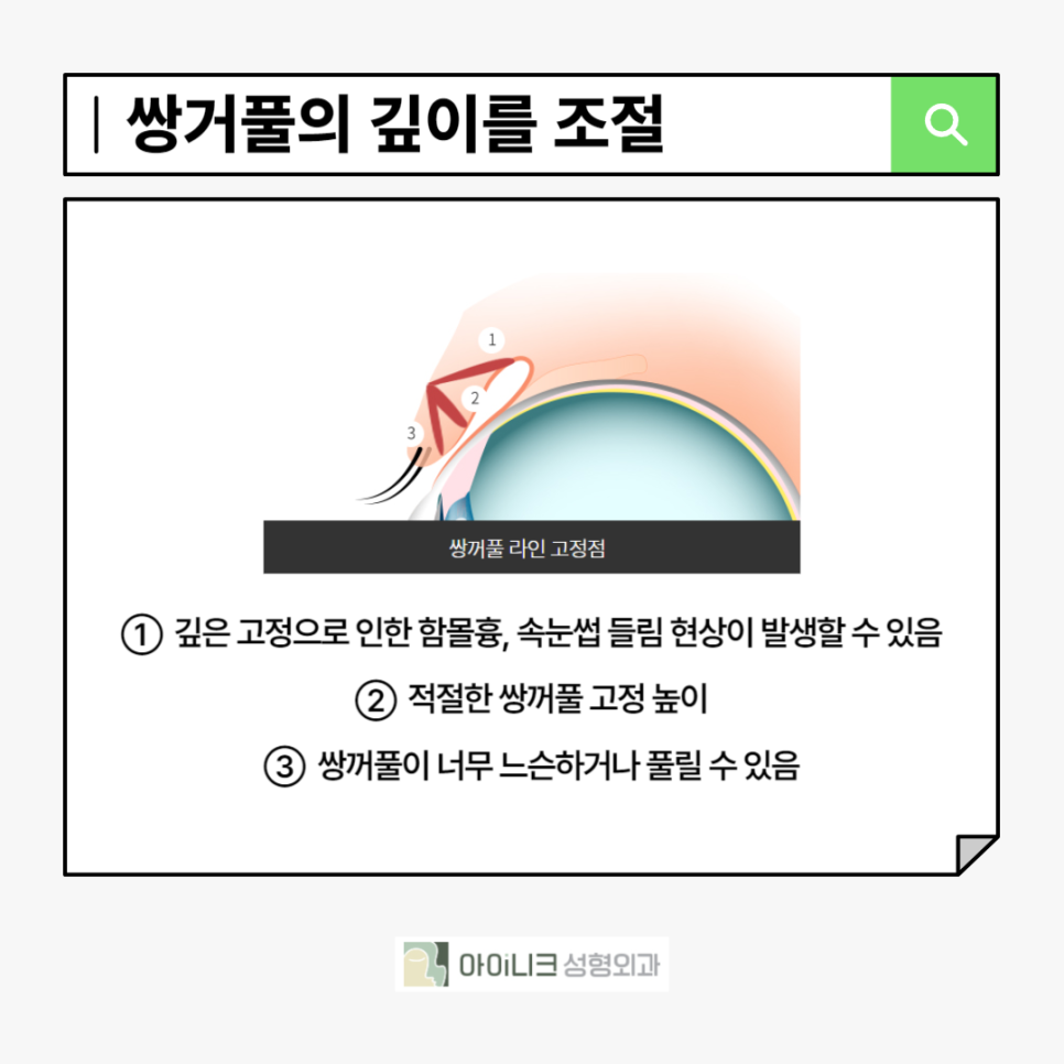 눈성형재수술, 고민하고 있다면 관련 이미지 4