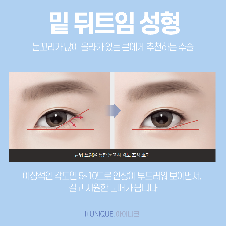 눈트임수술 어떤 것을 해야할지 고민이라면 아이니크성형외과에서 상담받자 관련 이미지 5
