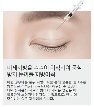 풀린쌍꺼풀 여러 겹의 쌍꺼풀 개선하는 방법! 관련 이미지 5