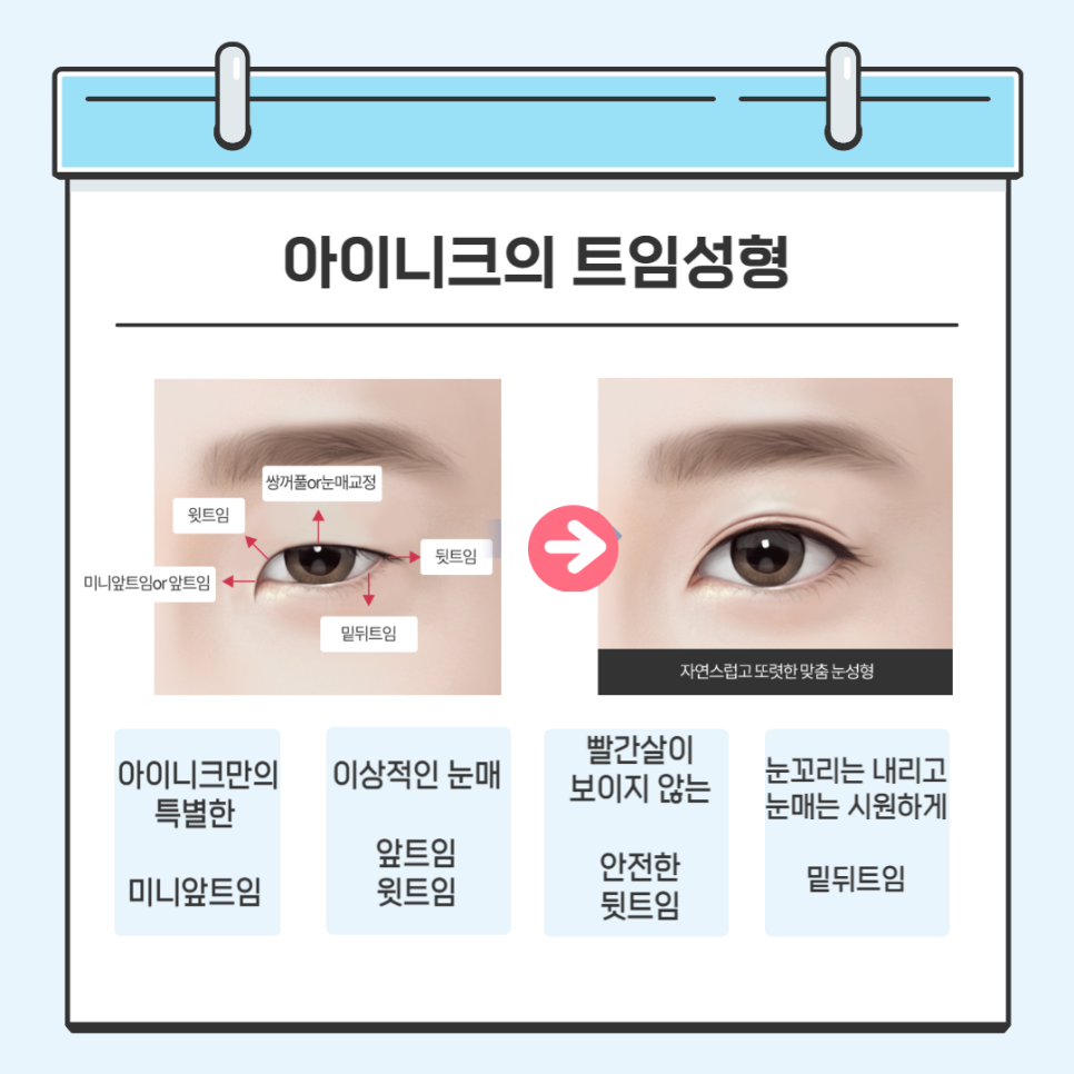 밑트임수술 안전하게 할 수 있는 방법 관련 이미지 2