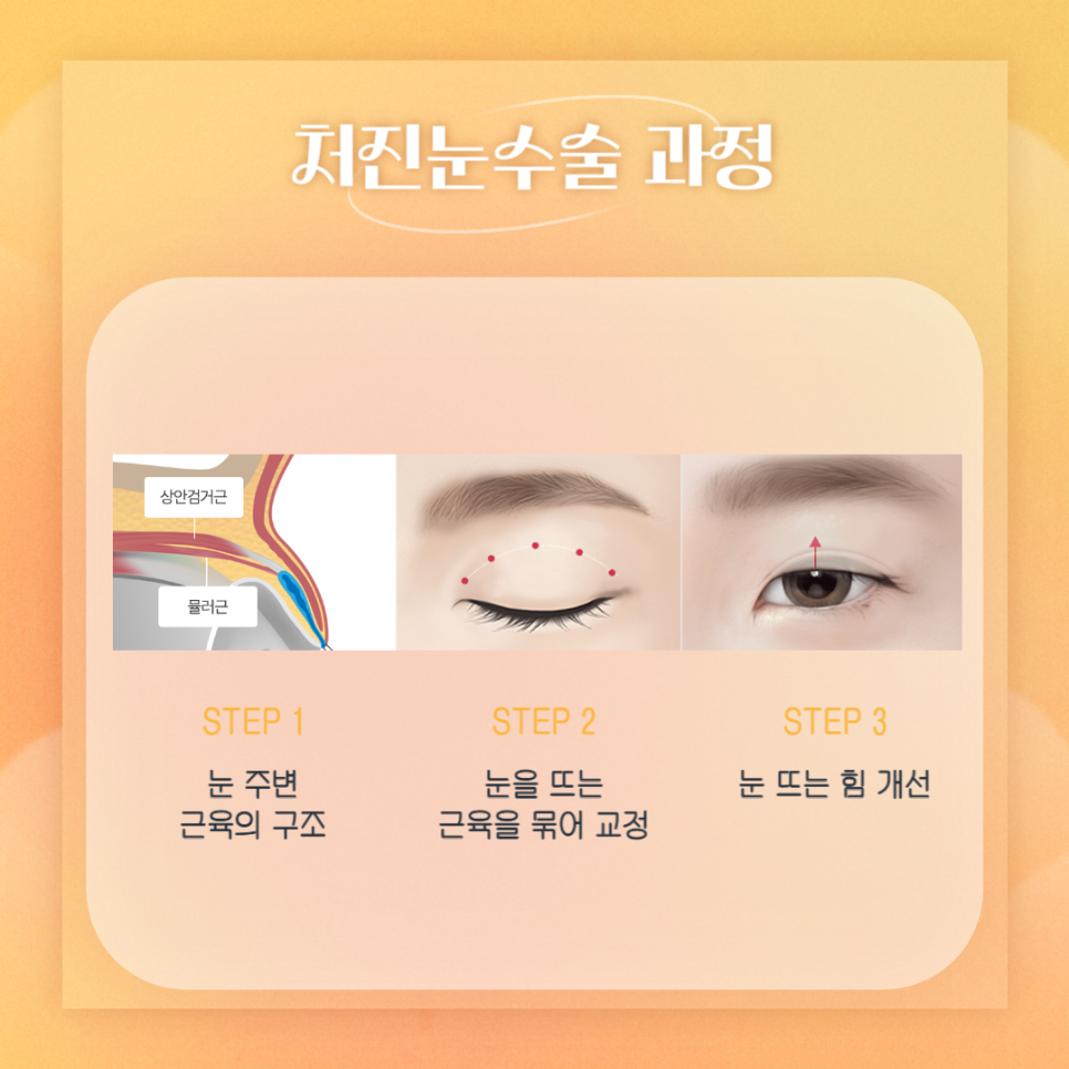처진눈수술, 안전하고 회복이 빠른 아이니크 관련 이미지 3