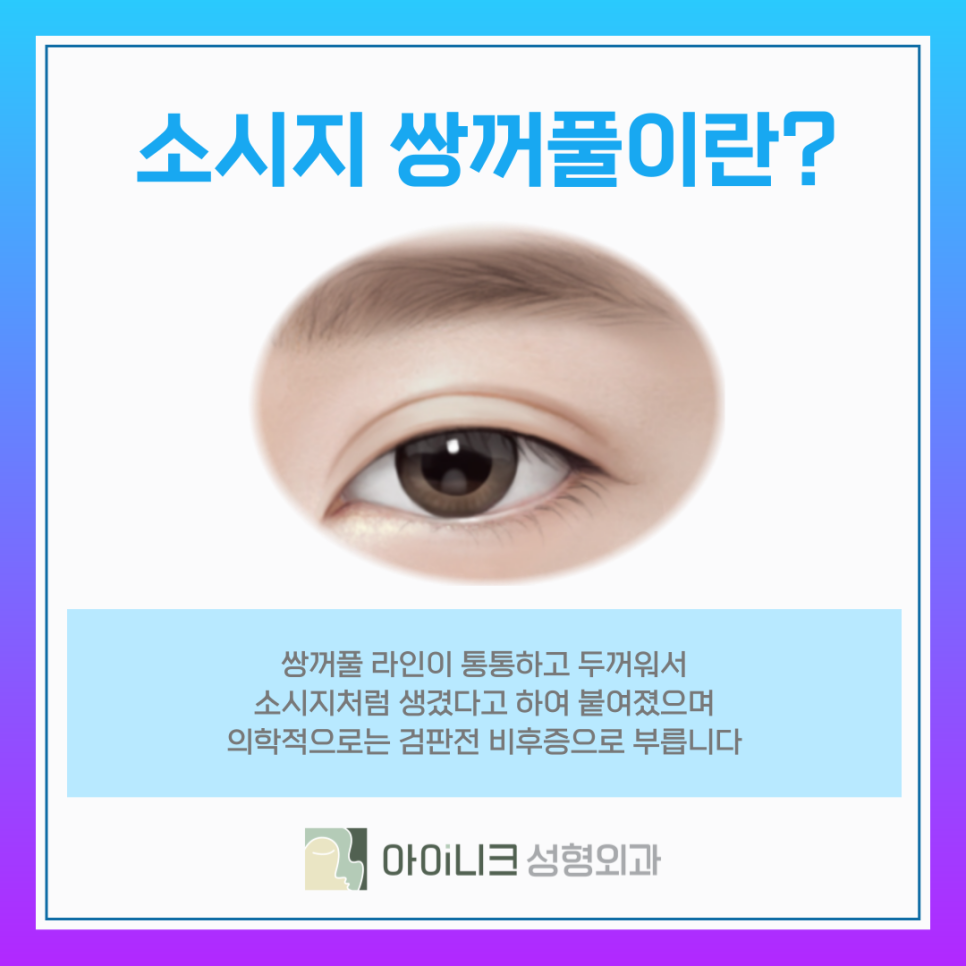 눈재수술비용 보다 중요한 소시지 쌍꺼풀 개선방식 관련 이미지 7