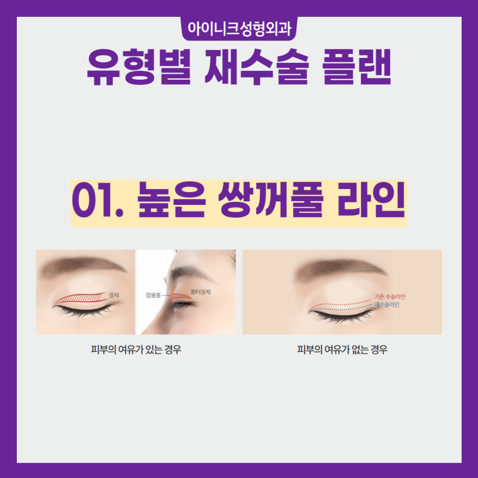 실패 없는 압구정눈성형 재수술 플랜 관련 이미지 3