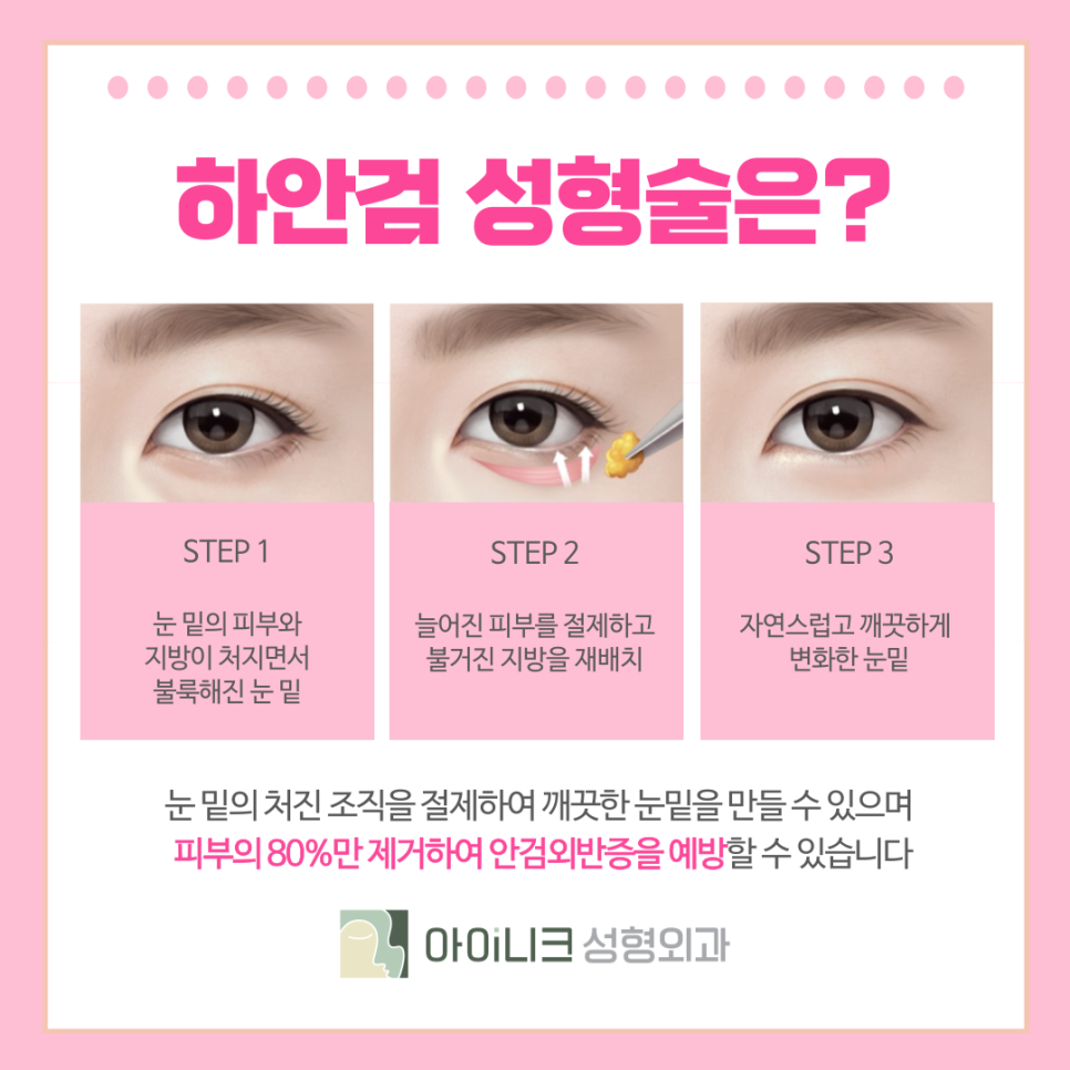 압구정 중년눈성형 시간을 되돌리고 싶다면? 관련 이미지 6