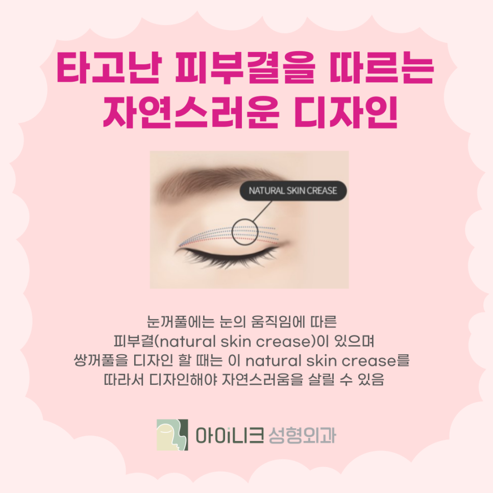 눈성형외과추천 자연스러움을 살리는 방법 관련 이미지 4