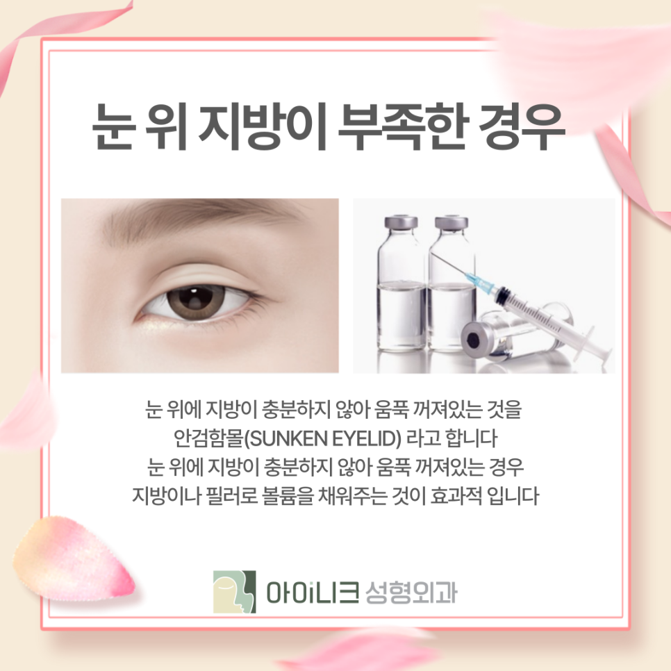쌍수재수술병원 부담스러운 소시지눈 개선하기 관련 이미지 13