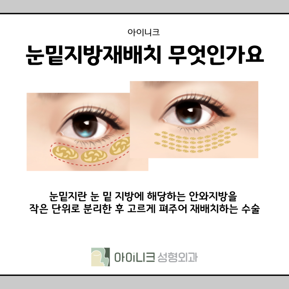 If You're Worried About Under-Eye Hollows and Bulging Dark Circles at an Under-Eye Clinic image 9