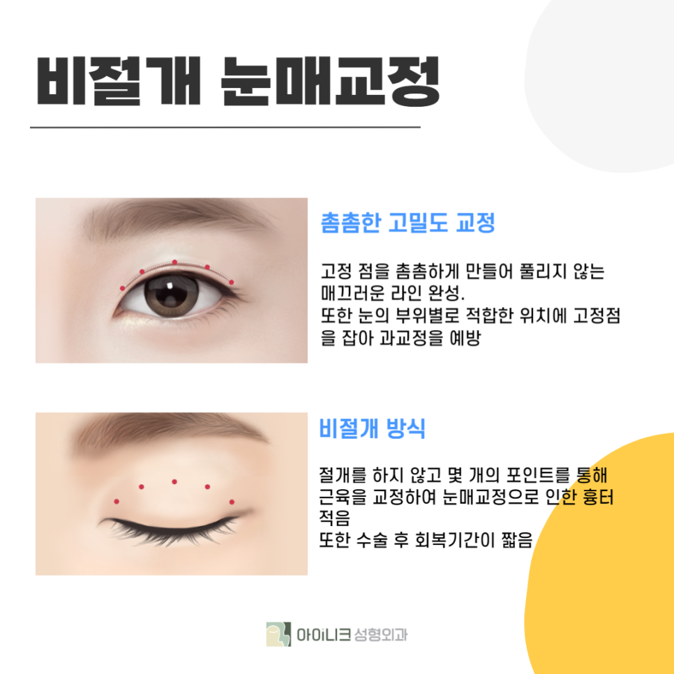 처진눈꺼풀개선이 필요하다면 주목! 관련 이미지 4