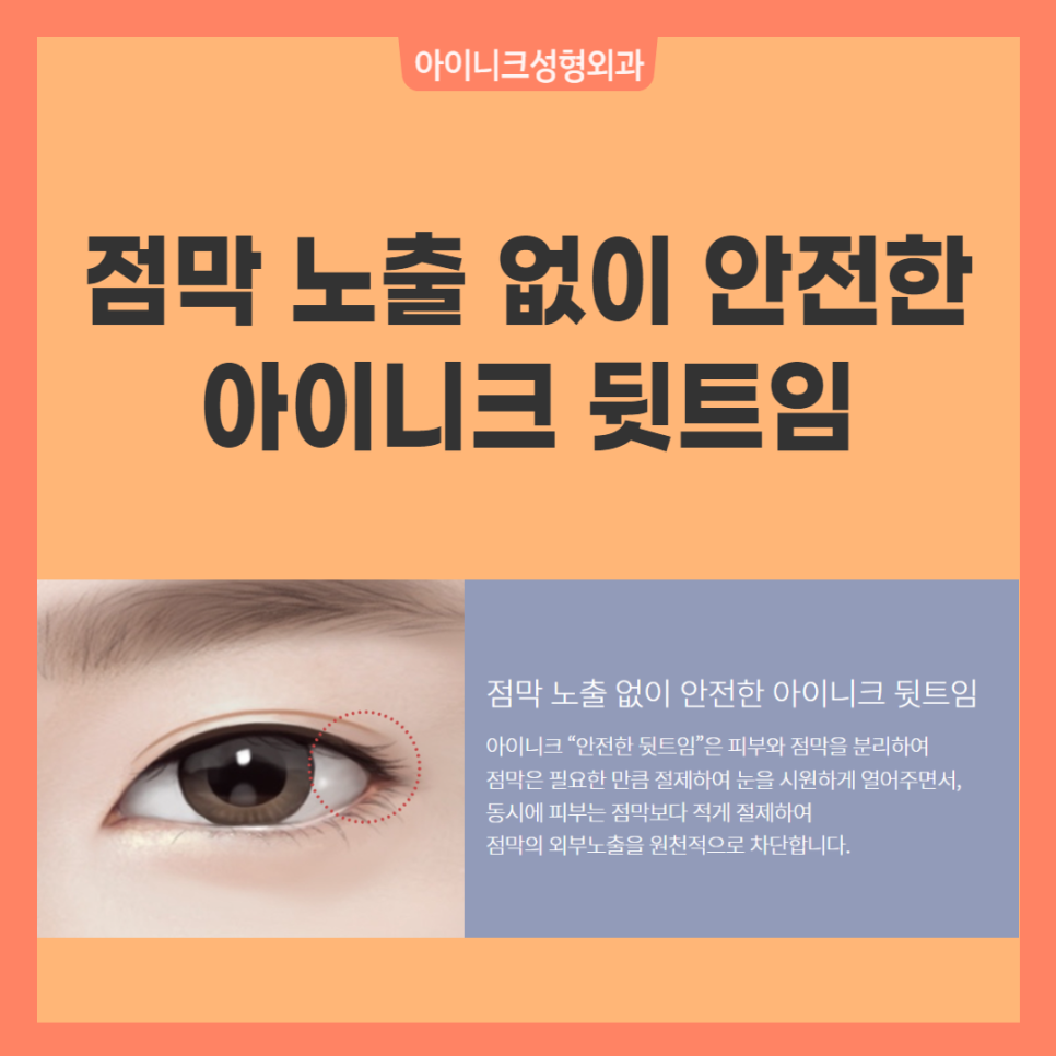 뒤트임성형 자연스러운 아름다움을 위해 관련 이미지 3