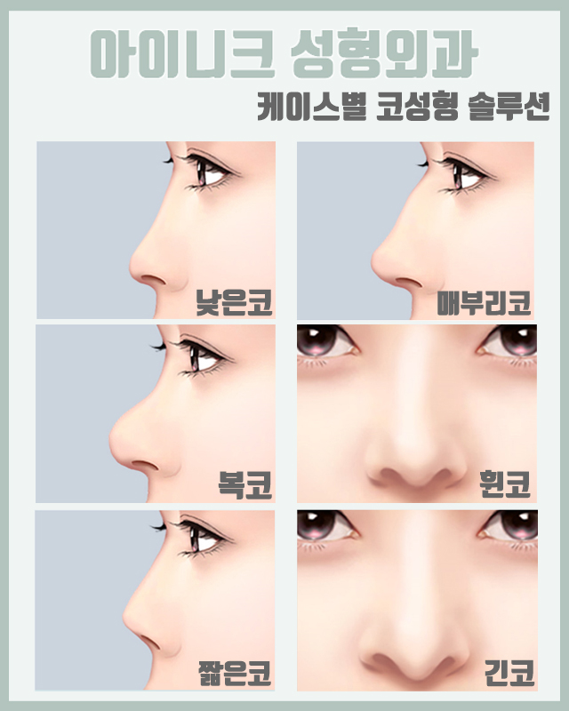 화살코성형후기 정면, 측면 모두 완벽하게! 관련 이미지 5