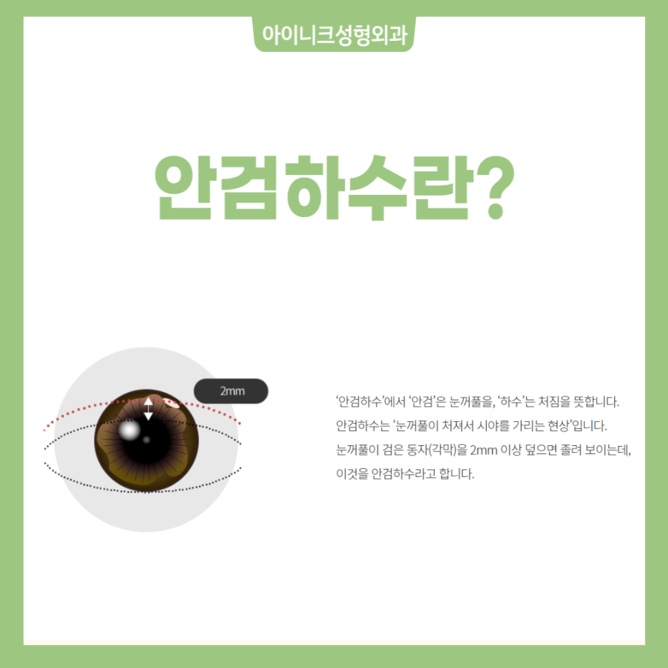 졸린눈수술로 또렷한 눈매를 만들자! 관련 이미지 2