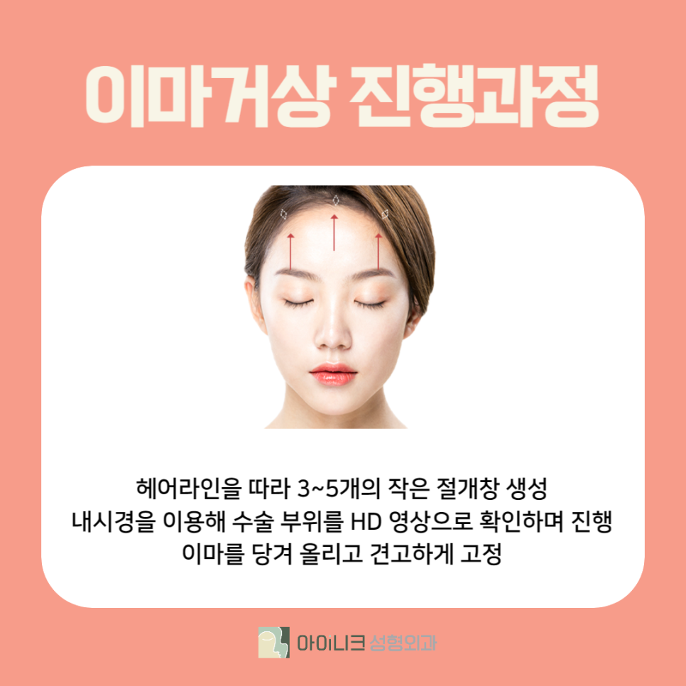 이마거상성형외과에서 노안 해결! 관련 이미지 3