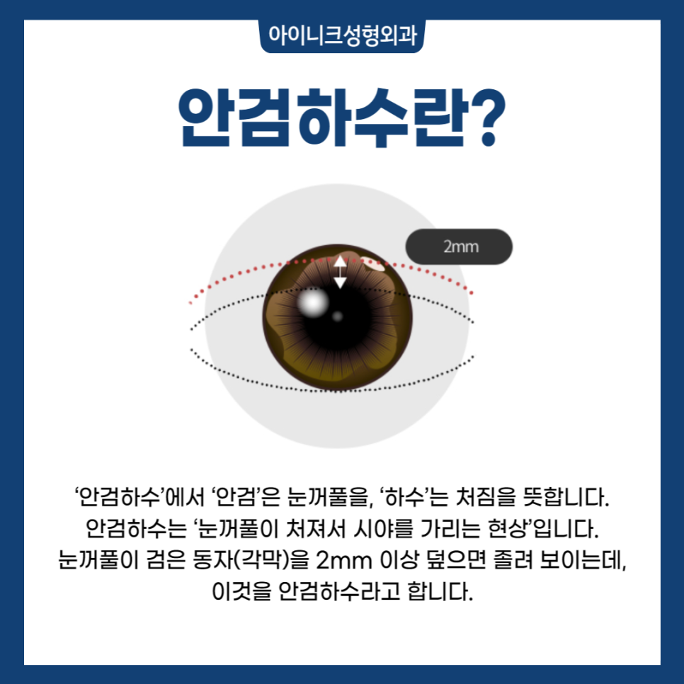 눈매교정수술전후, 또렷한 차이! 관련 이미지 2