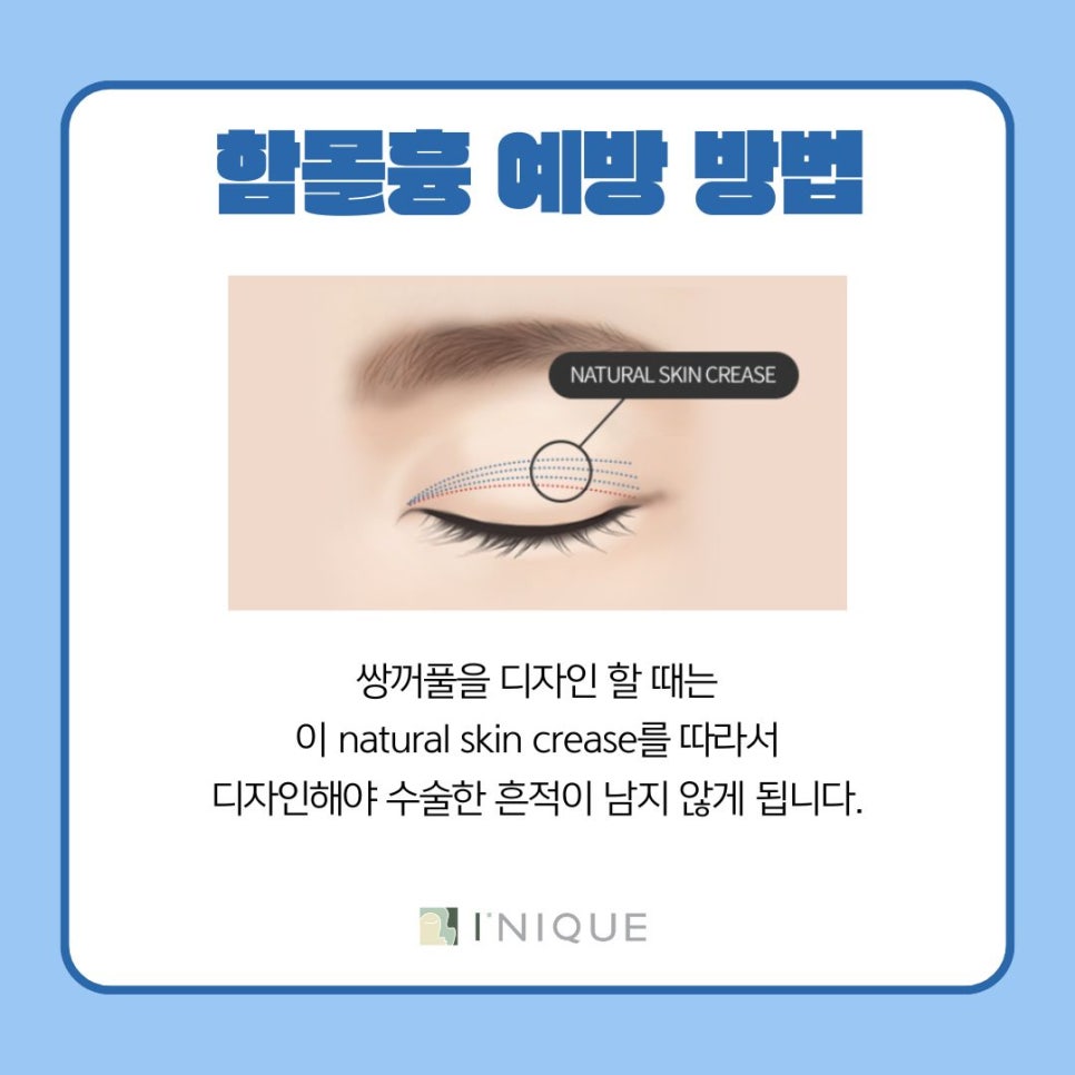 쌍꺼풀수술 후 흉터가 고민이라면 관련 이미지 5
