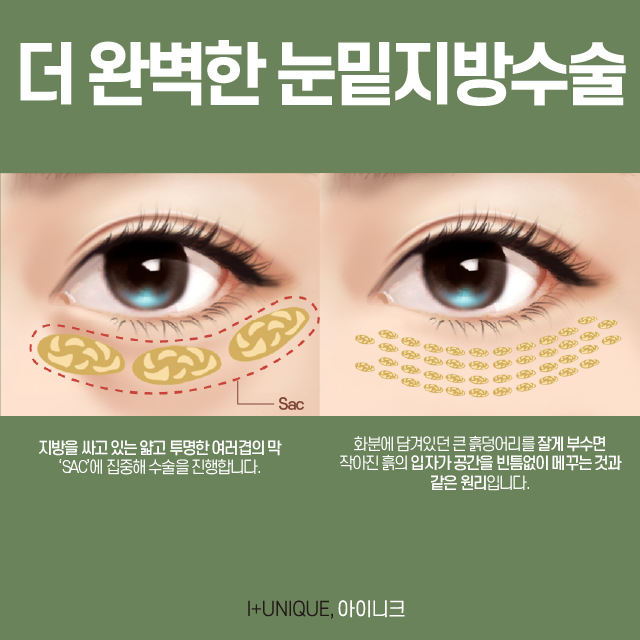 성공하는 눈밑지방수술 방법은? 관련 이미지 3
