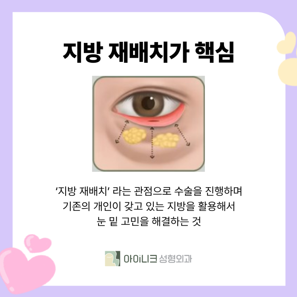 How to Manage Bruising After Under-Eye Fat Repositioning image 3