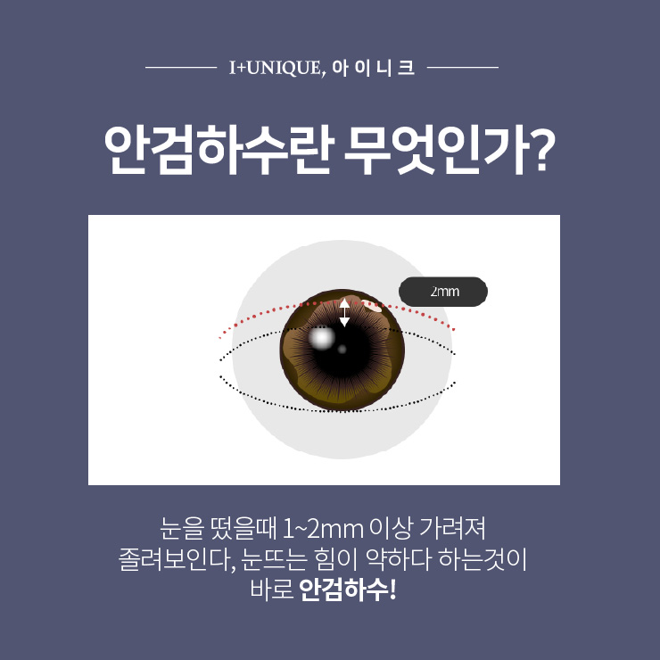 눈매교정 유명한 곳 찾는다면 ㅇㅇㄴㅋ 성형 관련 이미지 2
