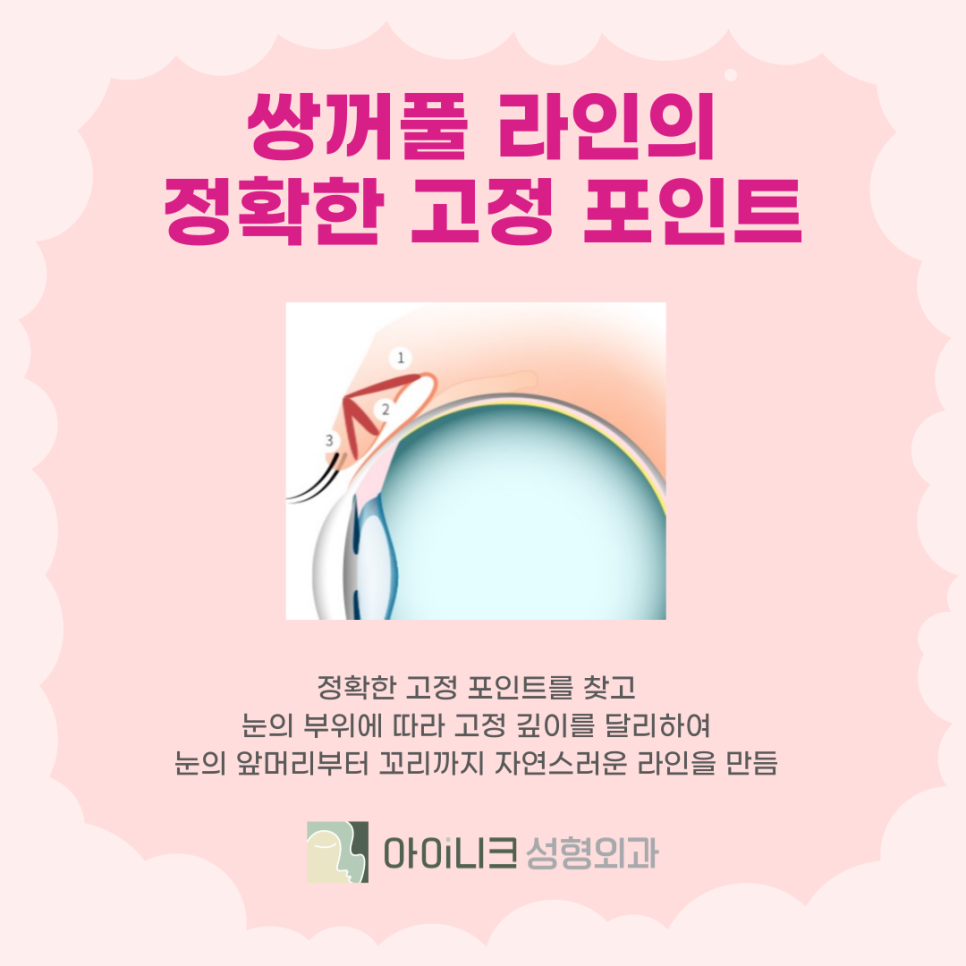 눈성형외과추천 자연스러움을 살리는 방법 관련 이미지 5
