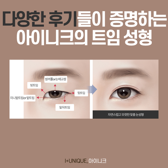 트임 성형의 종류, 그리고 트임 후기! 관련 이미지 6