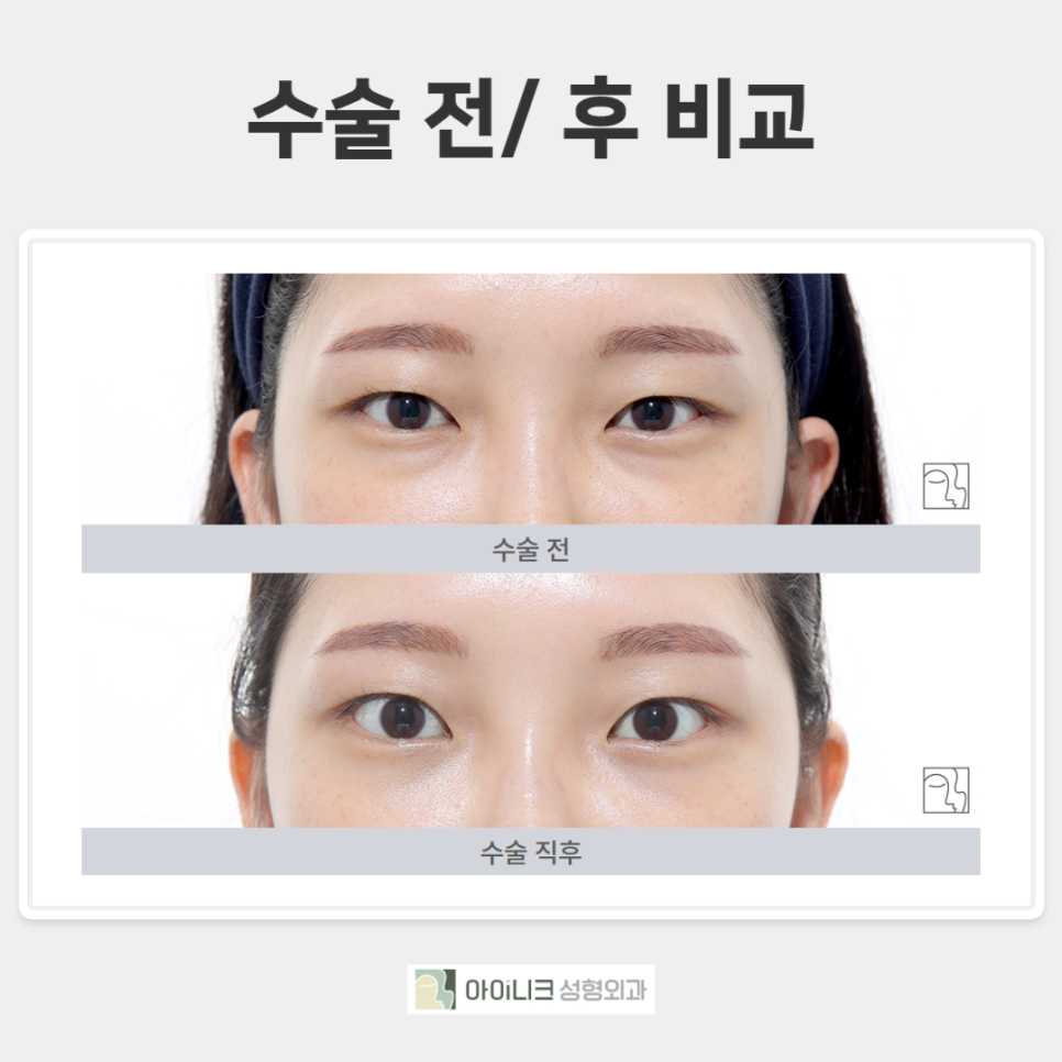 앙코르 눈밑지방재배치 알아보기! 관련 이미지 4