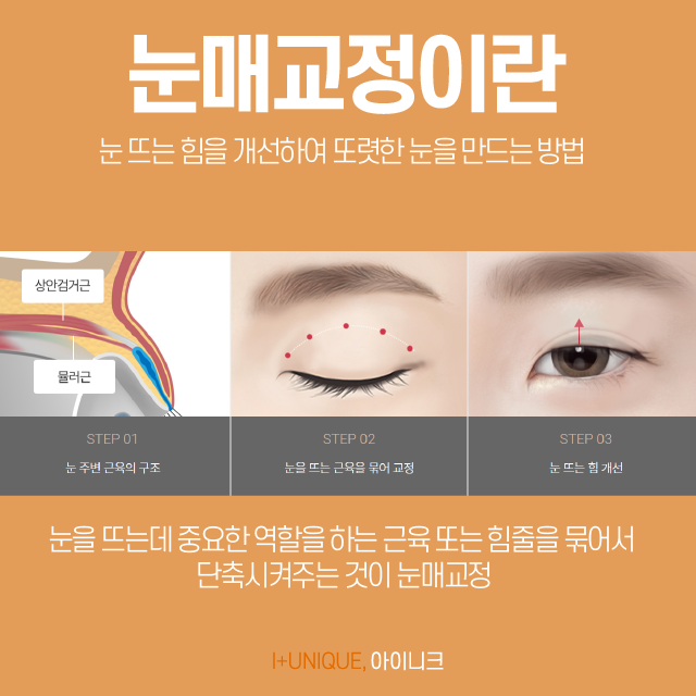 압구정눈매교정, 원인부터 결과까지 확실하게 알아야 합니다. 관련 이미지 3