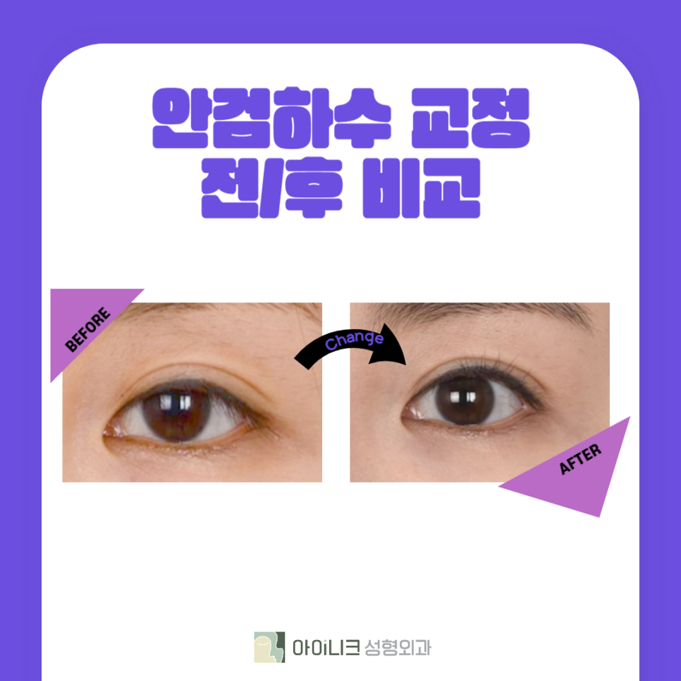 40대안검하수 고려하고 있다면 관련 이미지 6