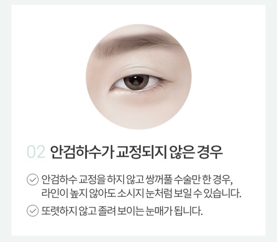 소시지눈재수술 자연스러움이 가장 중요 관련 이미지 3
