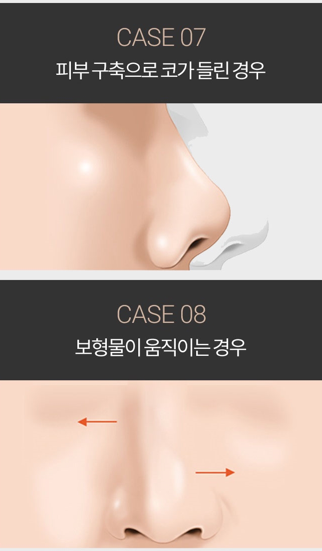 코재건수술 두 번의 실수는 없다! 관련 이미지 6