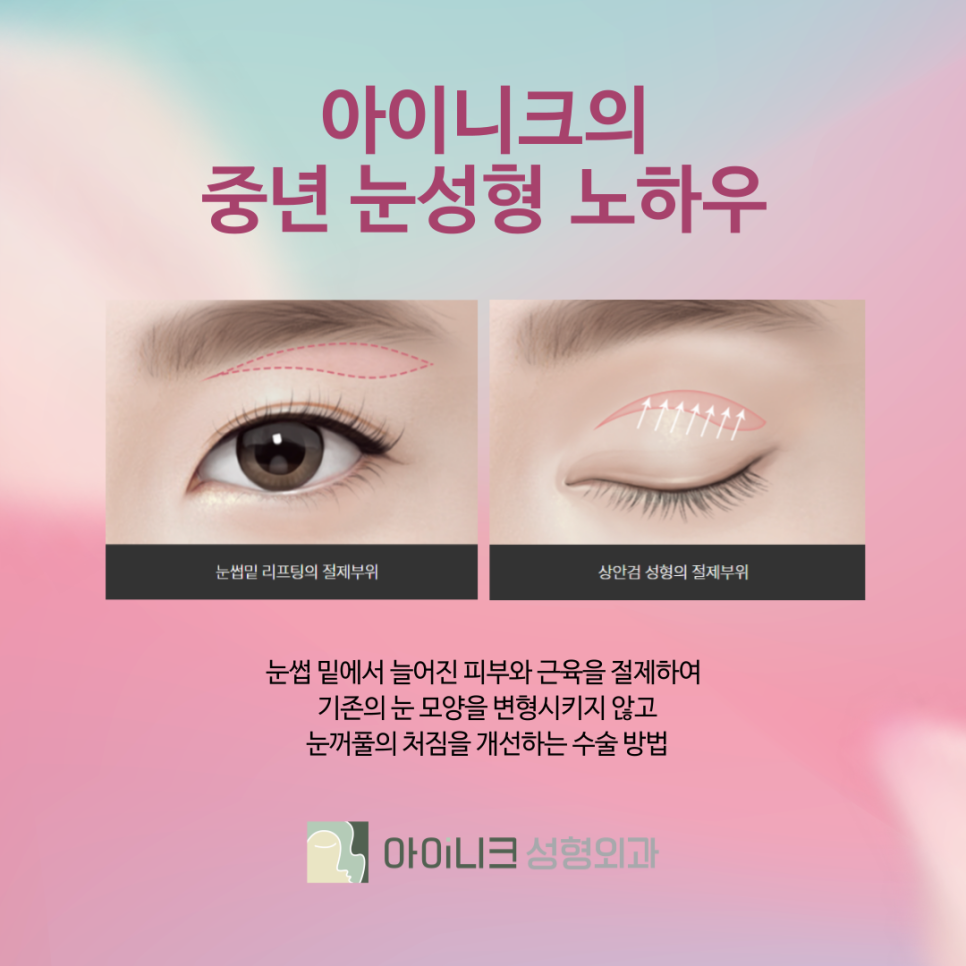 Apgujeong Lower Blepharoplasty for Brighter, Cleaner Under-Eyes image 3