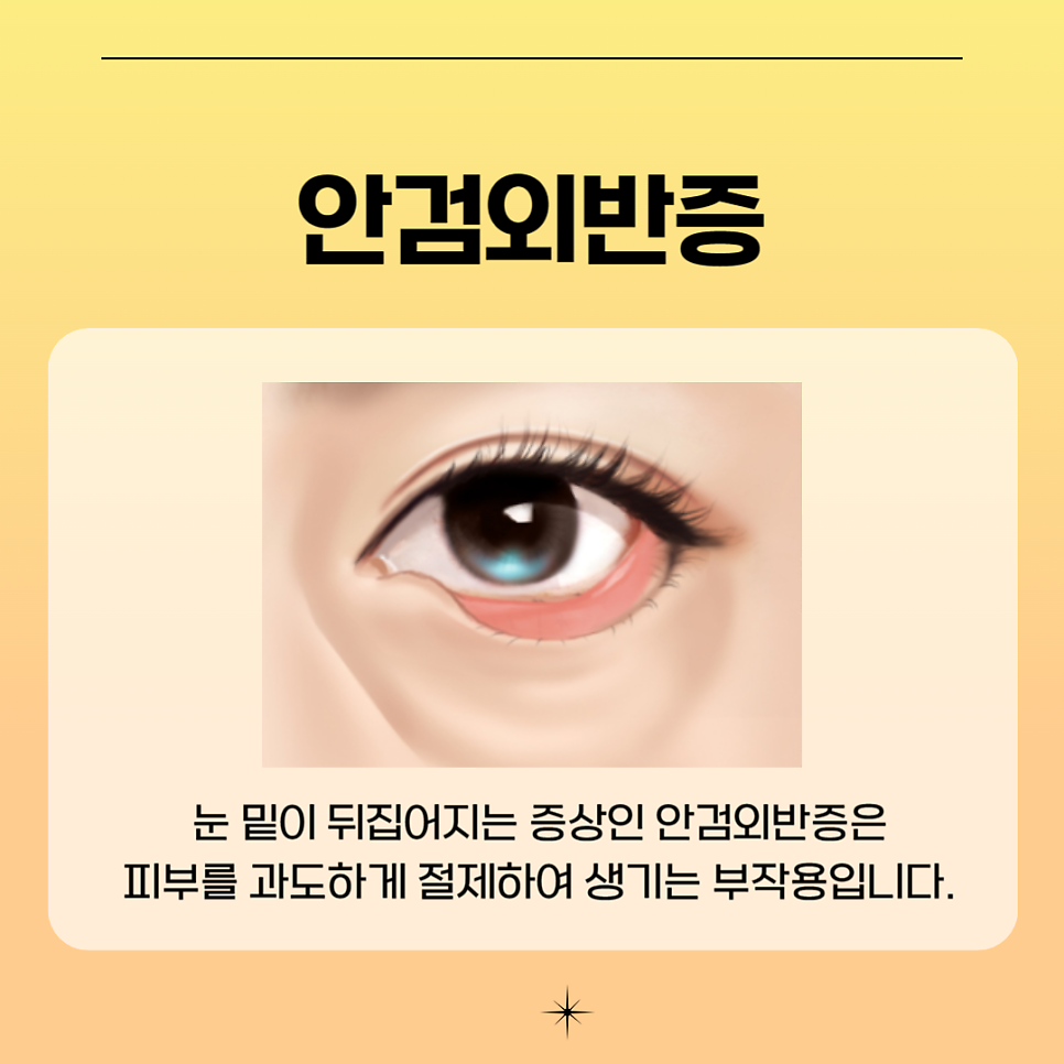 눈처짐수술 후기가 증명하는 아이니크 관련 이미지 5