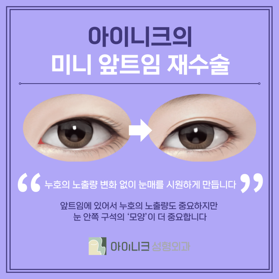 압구정눈재수술잘하는곳 실패를 성공으로 바꾸기 관련 이미지 8
