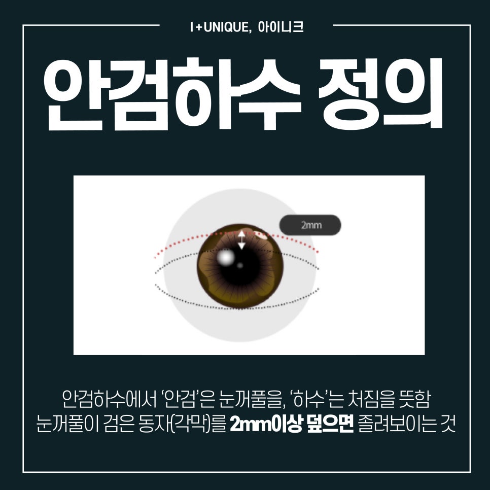 안검하수수술병원 답은 여기 아이니크성형외과 관련 이미지 3