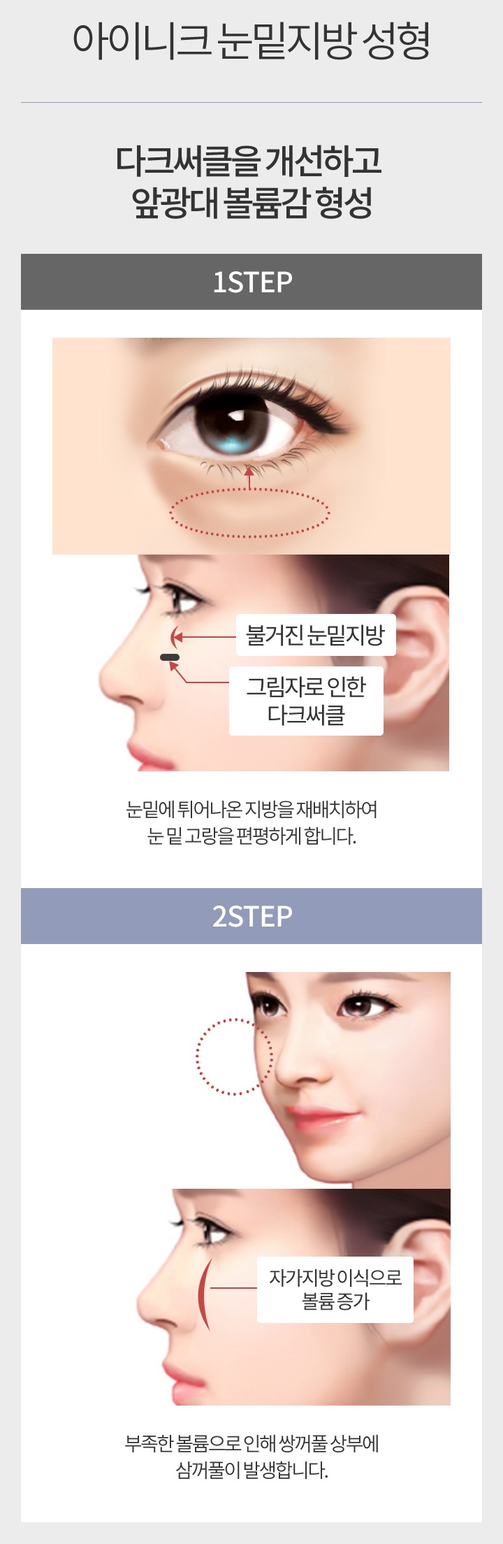 다크서클수술비용이 궁금하다면? 관련 이미지 3