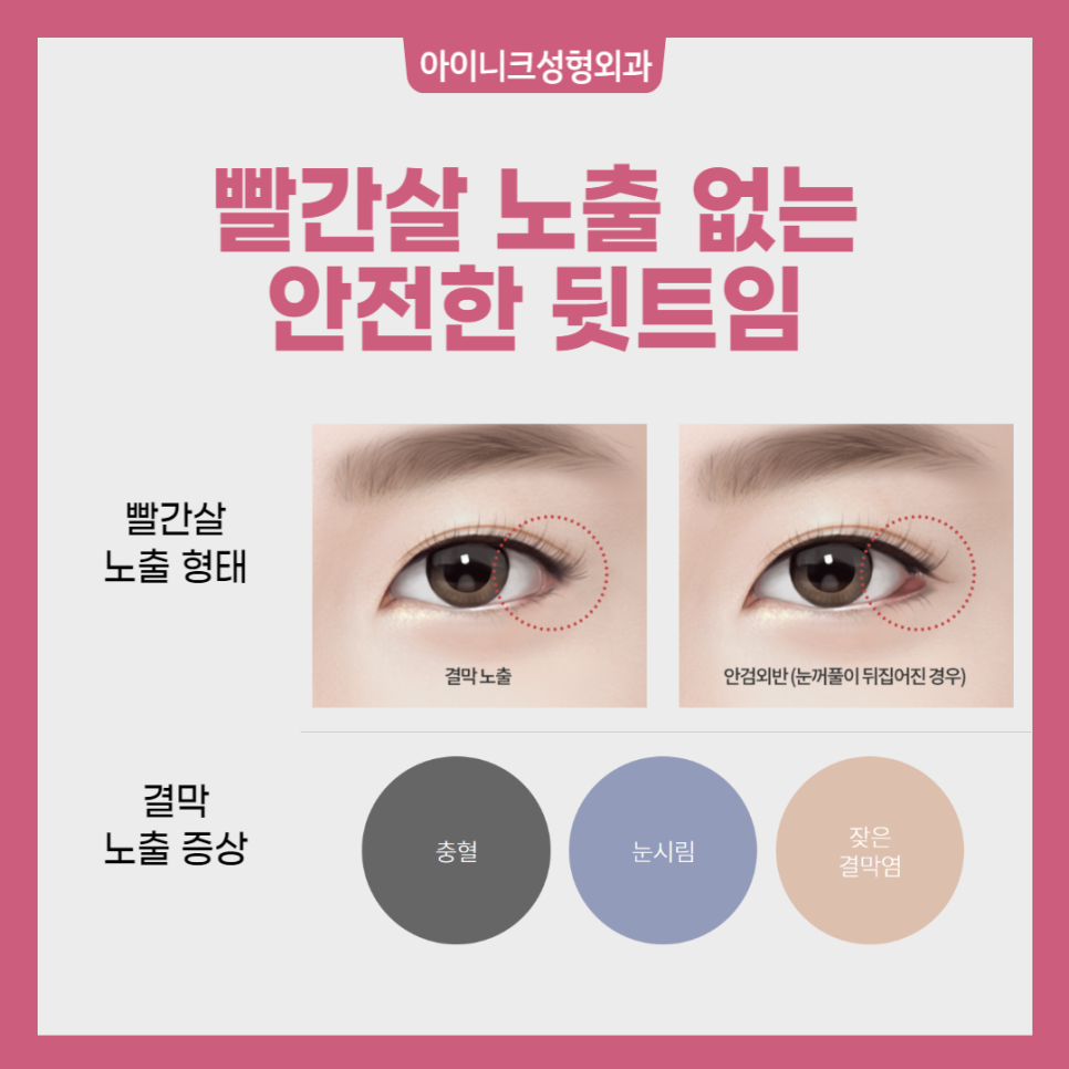 Blepharoplasty for Large, Beautiful Eyes image 4