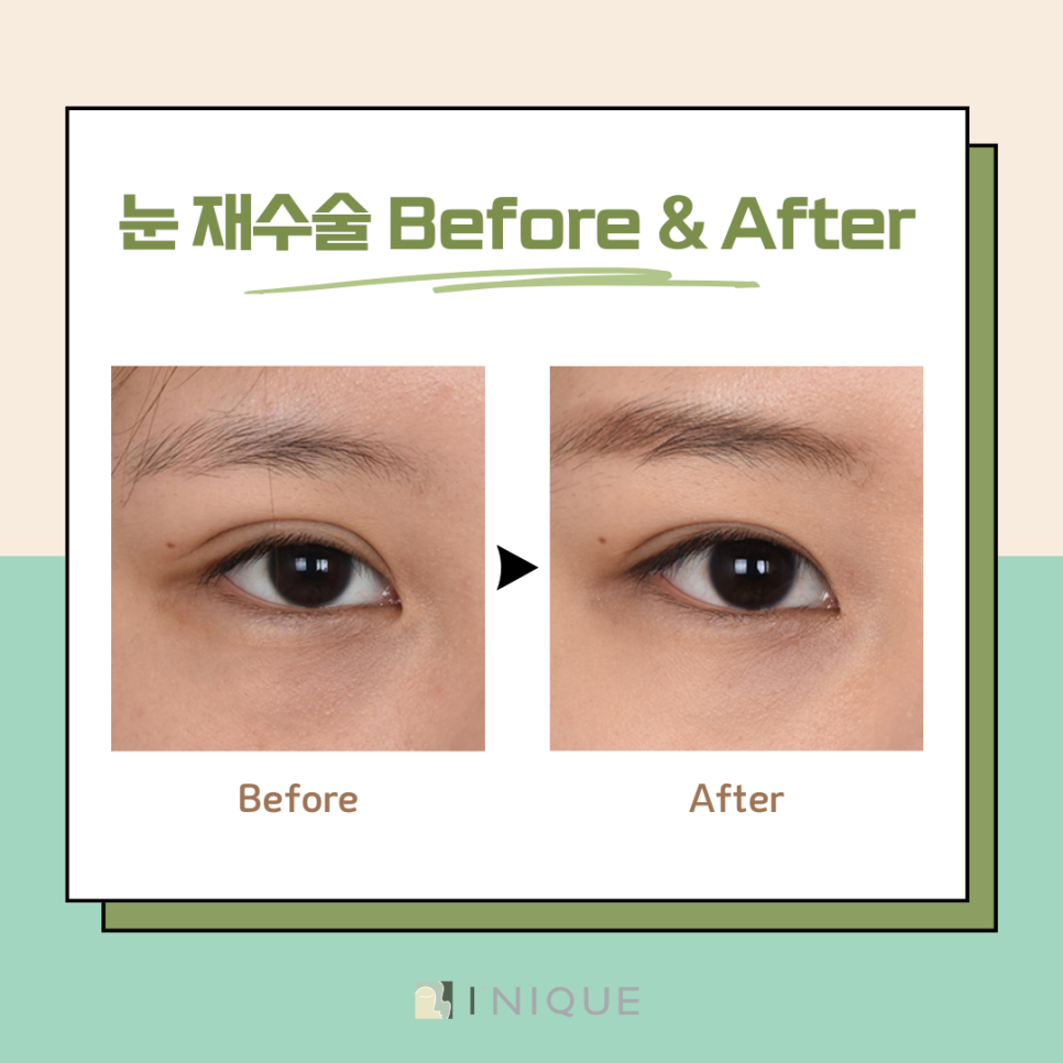 What Is the Solution for Unnatural Double Eyelids at a Place Known for Revision Eyelid Surgery in Apgujeong? image 7