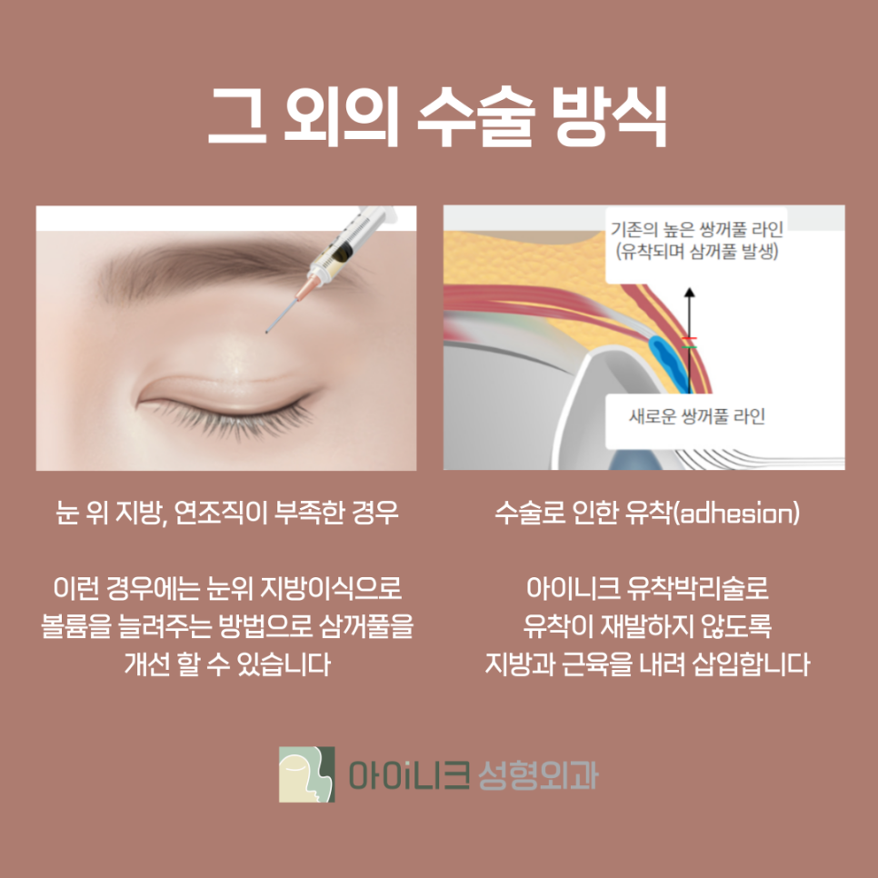쌍수절개재수술 3중 고정으로 견고하게 관련 이미지 11